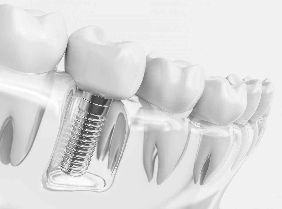 Dental Implantsfeatured image