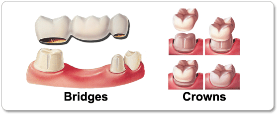 crowns-vs-bridges